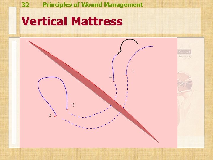 32 Principles of Wound Management Vertical Mattress 32 Principles of Wound Management Vertical Mattress