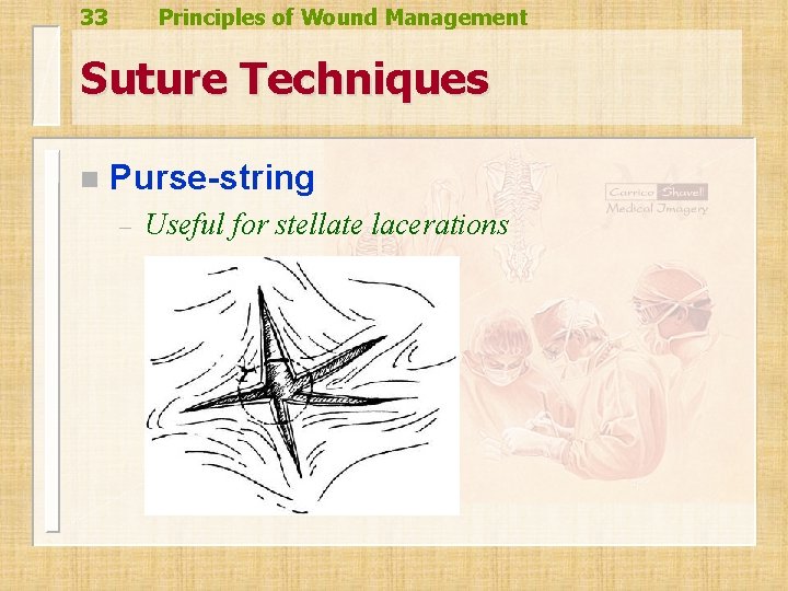 33 Principles of Wound Management Suture Techniques n Purse-string – Useful for stellate lacerations 33 Principles of Wound Management Suture Techniques n Purse-string – Useful for stellate lacerations