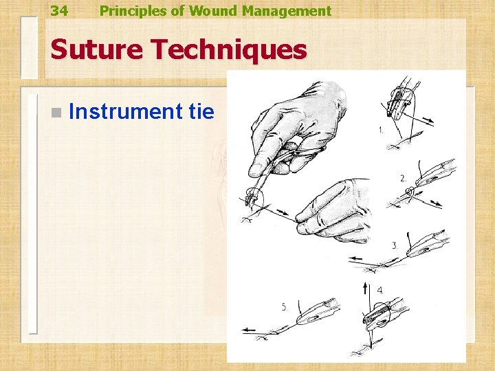 34 Principles of Wound Management Suture Techniques n Instrument tie 34 Principles of Wound Management Suture Techniques n Instrument tie