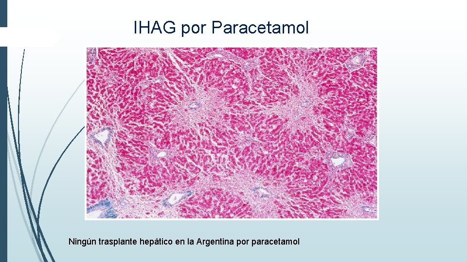 IHAG por Paracetamol Ningún trasplante hepático en la Argentina por paracetamol IHAG por Paracetamol Ningún trasplante hepático en la Argentina por paracetamol