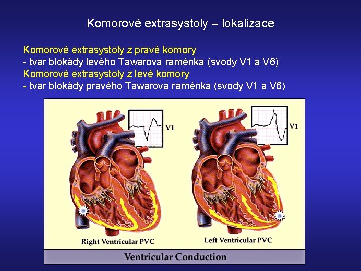 Komorové extrasystoly – lokalizace Komorové extrasystoly z pravé komory - tvar blokády levého Tawarova