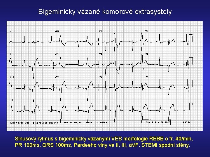 Bigeminicky vázané komorové extrasystoly Sinusový rytmus s bigeminicky vázanými VES morfologie RBBB o fr.