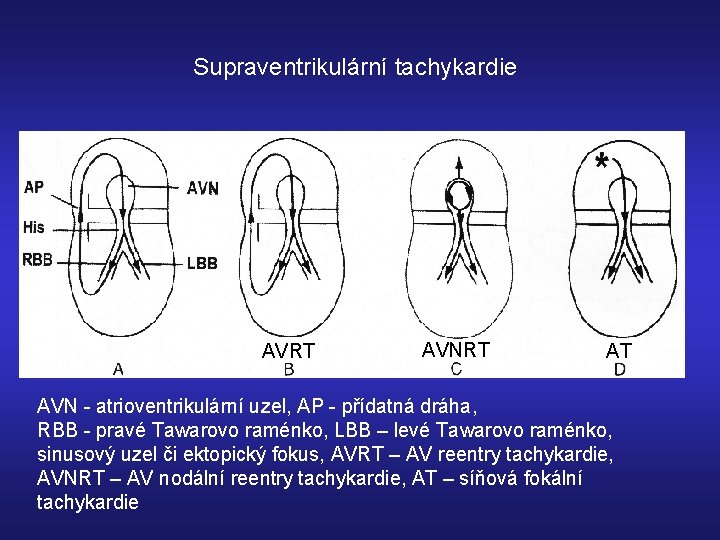 Supraventrikulární tachykardie AVRT AVNRT AT AVN - atrioventrikulární uzel, AP - přídatná dráha, RBB
