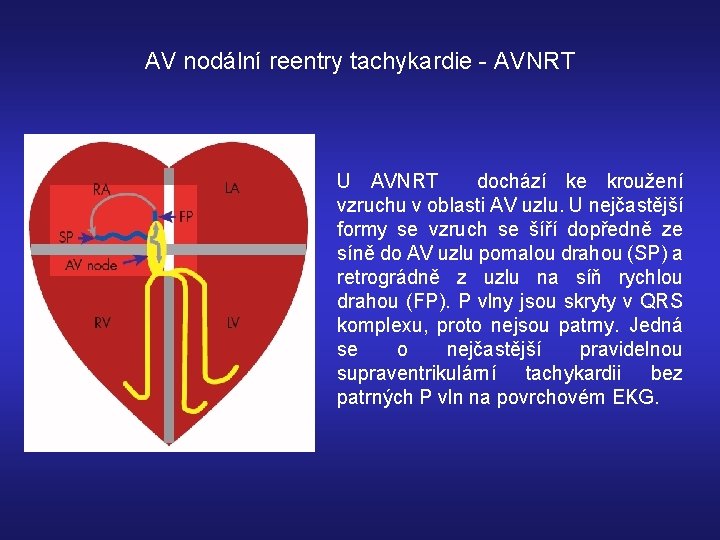 AV nodální reentry tachykardie - AVNRT U AVNRT dochází ke kroužení vzruchu v oblasti