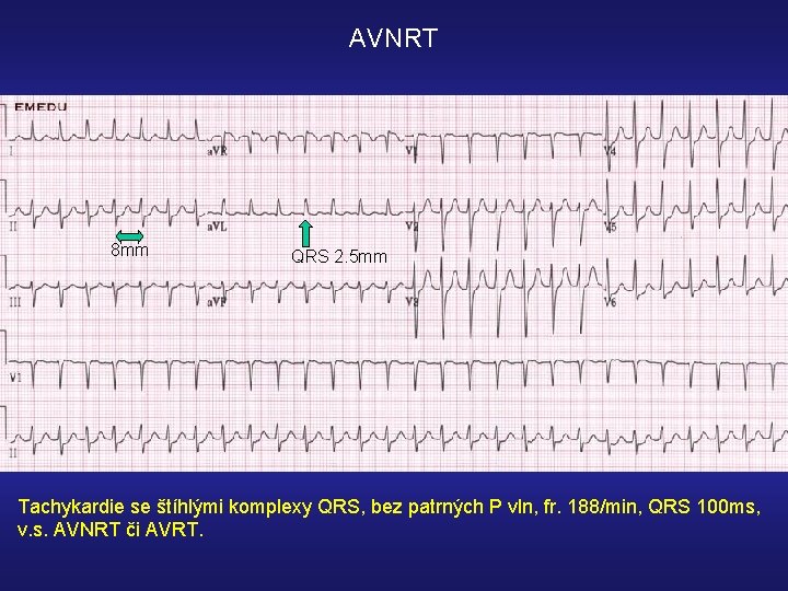 AVNRT 8 mm QRS 2. 5 mm Tachykardie se štíhlými komplexy QRS, bez patrných