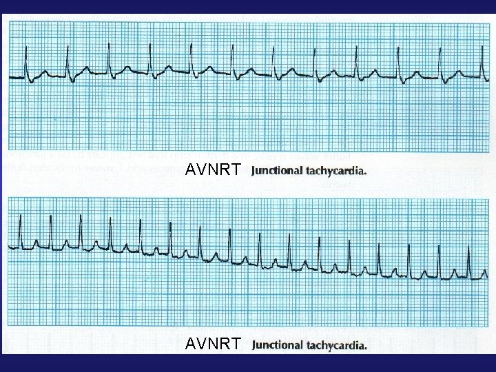 AVNRT 