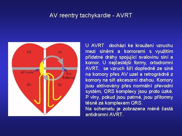 AV reentry tachykardie - AVRT U AVRT dochází ke kroužení vzruchu mezi síněmi a