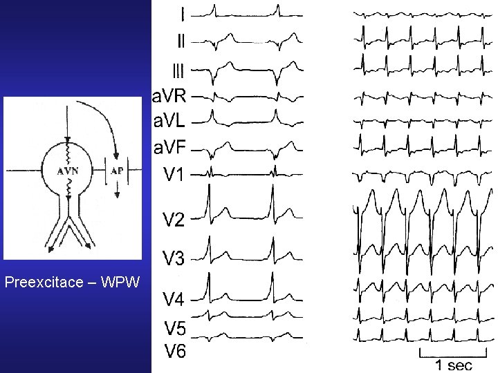 Preexcitace – WPW 