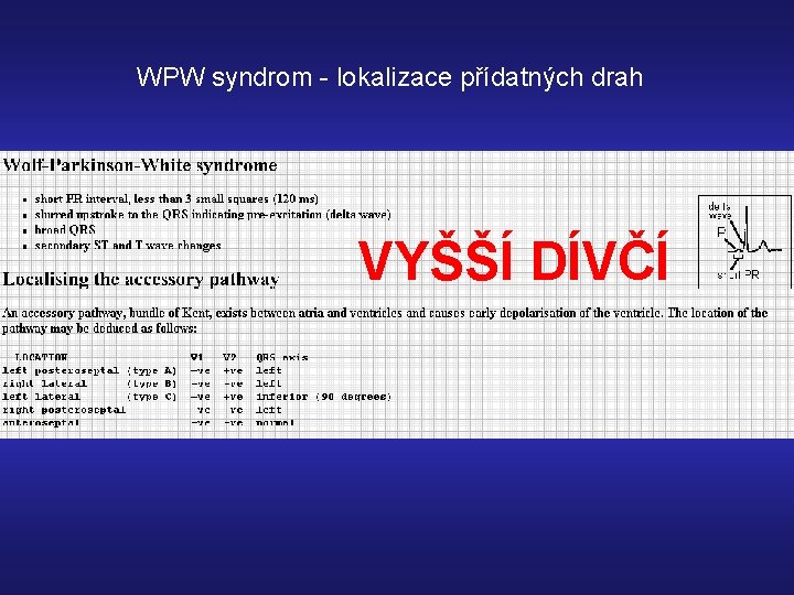 WPW syndrom - lokalizace přídatných drah VYŠŠÍ DÍVČÍ 