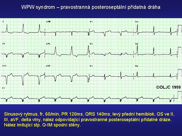 WPW syndrom – pravostranná posteroseptální přídatná dráha Sinusový rytmus, fr, 60/min, PR 120 ms,