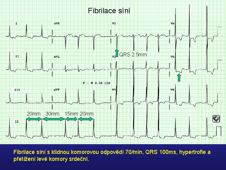 Fibrilace síní QRS 2. 5 mm 20 mm 30 mm 15 mm 20 mm