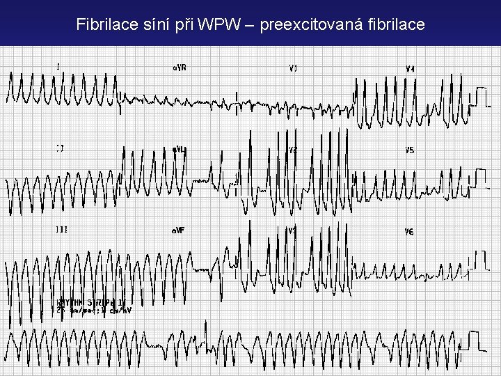 Fibrilace síní při WPW – preexcitovaná fibrilace 