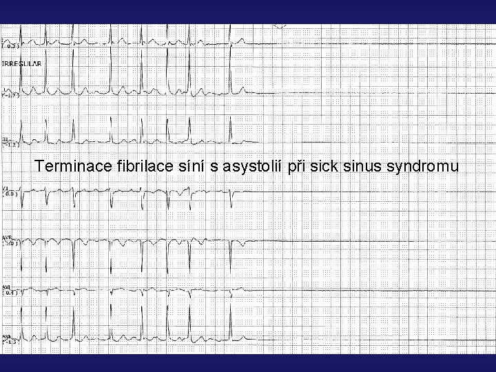 Terminace fibrilace síní s asystolií při sick sinus syndromu 