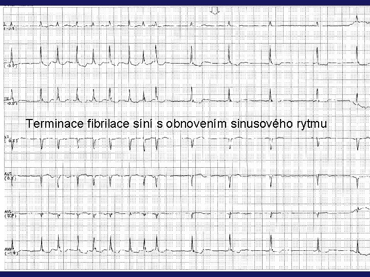 Terminace fibrilace síní s obnovením sinusového rytmu 