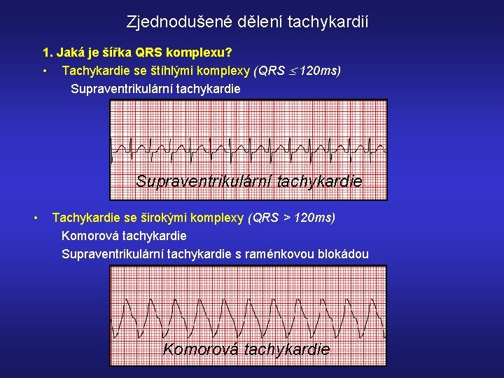 Zjednodušené dělení tachykardií 1. Jaká je šířka QRS komplexu? • Tachykardie se štíhlými komplexy