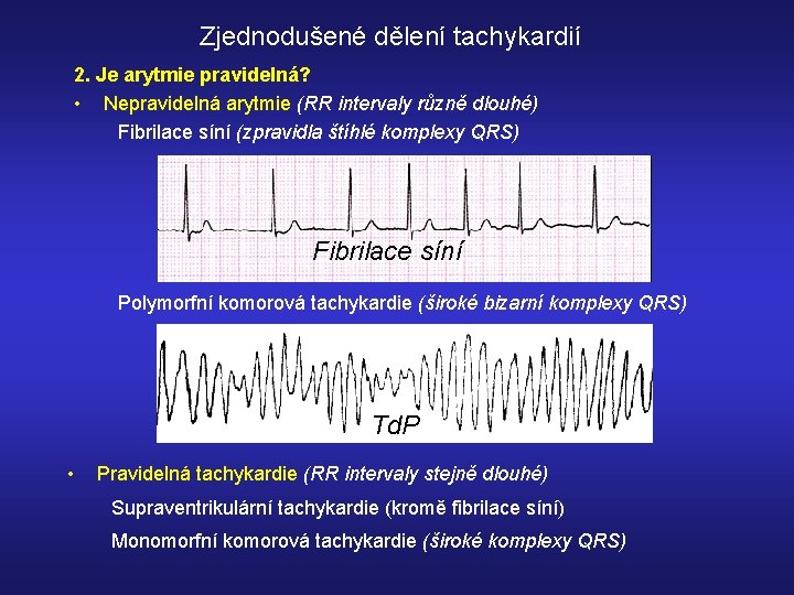 Zjednodušené dělení tachykardií 2. Je arytmie pravidelná? • Nepravidelná arytmie (RR intervaly různě dlouhé)