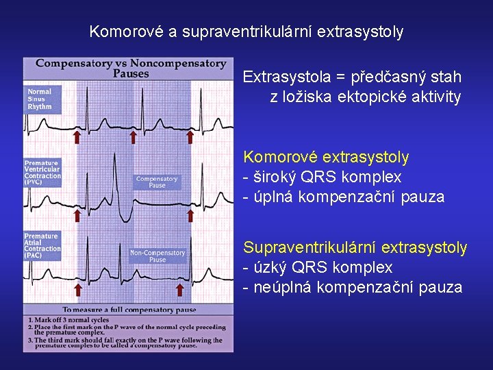 Komorové a supraventrikulární extrasystoly Extrasystola = předčasný stah z ložiska ektopické aktivity Komorové extrasystoly