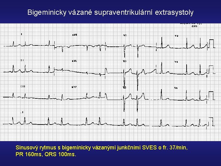 Bigeminicky vázané supraventrikulární extrasystoly Sinusový rytmus s bigeminicky vázanými junkčními SVES o fr. 37/min,