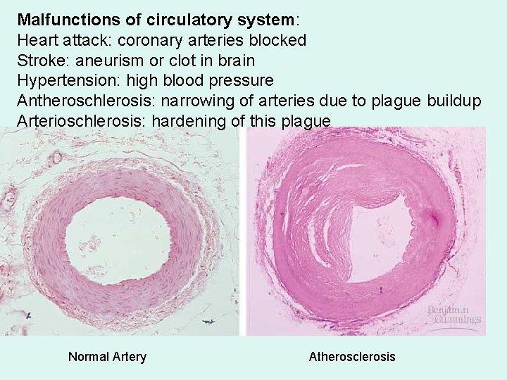 Malfunctions of circulatory system: Heart attack: coronary arteries blocked Stroke: aneurism or clot in