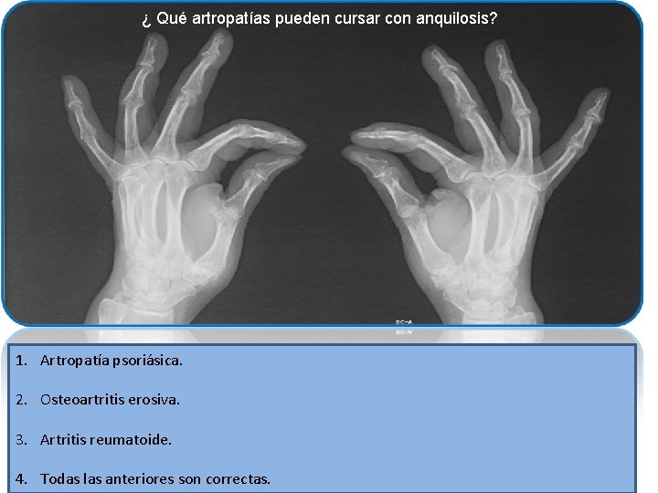 ¿ Qué artropatías pueden cursar con anquilosis? 1. Artropatía psoriásica. 2. Osteoartritis erosiva. 3.