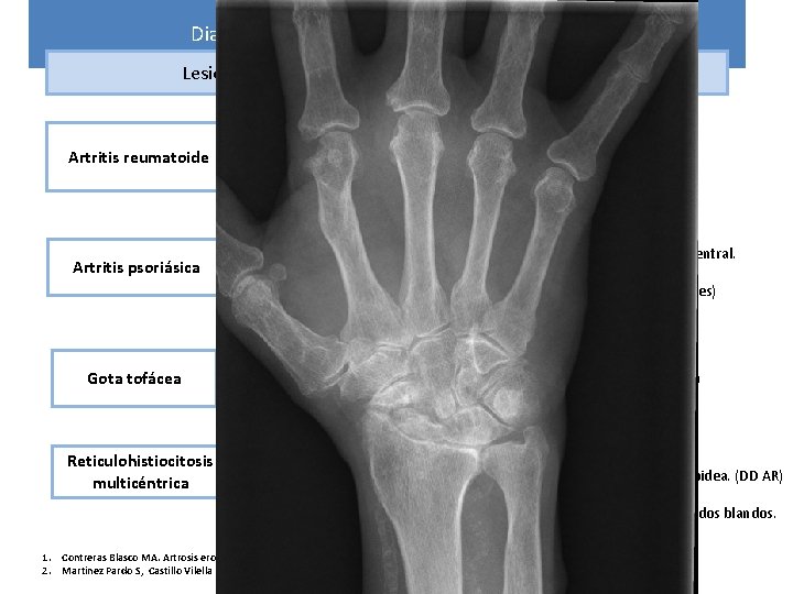 Diagnóstico diferencial Osteoartritis erosiva Lesiones erosivas en articulaciones interfalángicas Artritis reumatoide Artritis psoriásica Gota