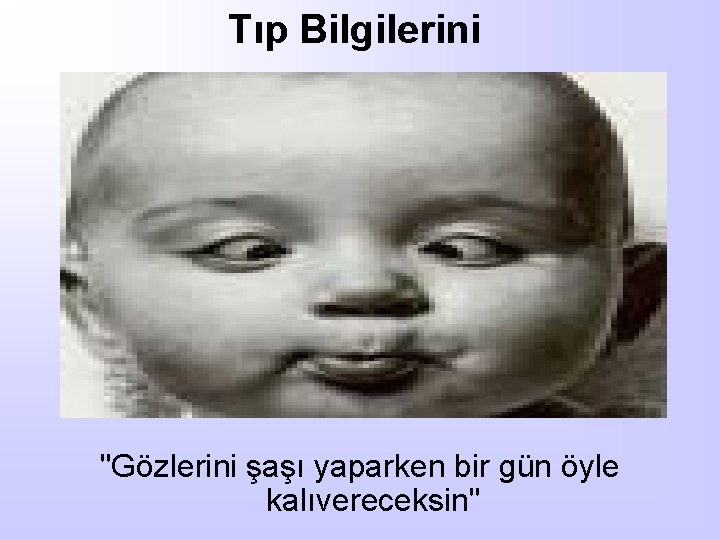 Tıp Bilgilerini "Gözlerini şaşı yaparken bir gün öyle kalıvereceksin" 