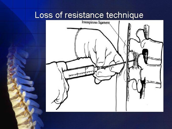 Loss of resistance technique 