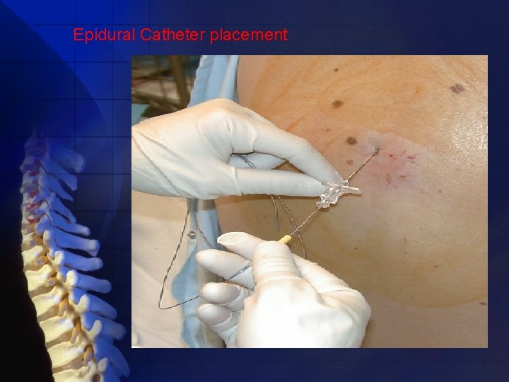 Epidural Catheter placement 