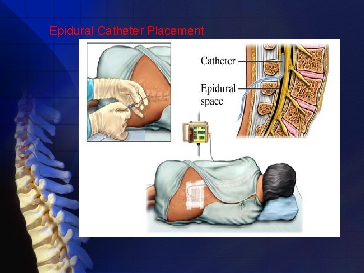 Epidural Catheter Placement 