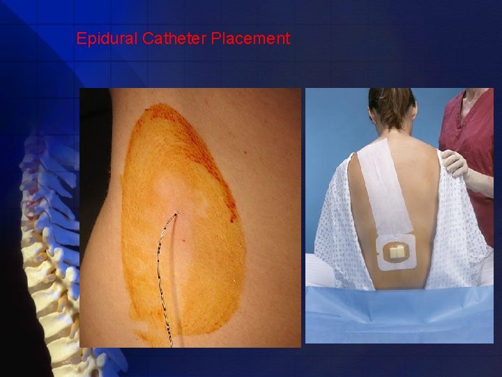 Epidural Catheter Placement 