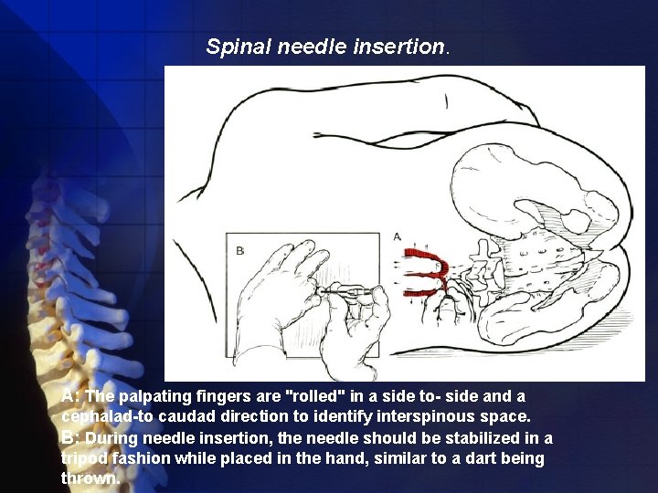 Spinal needle insertion. A: The palpating fingers are "rolled" in a side to- side