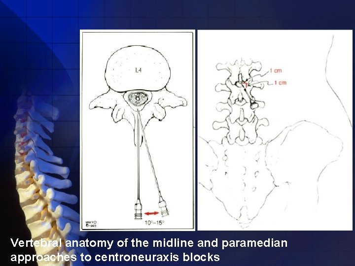 Vertebral anatomy of the midline and paramedian approaches to centroneuraxis blocks 