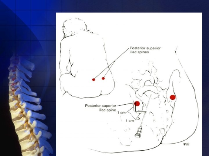 Neuraxial anatomy of the Taylor approach to spinal anesthesia. 