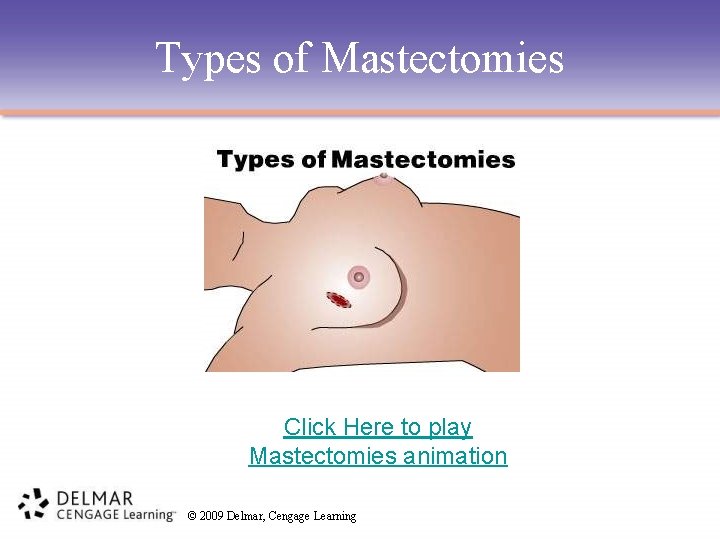 Types of Mastectomies Click Here to play Mastectomies animation © 2009 Delmar, Cengage Learning