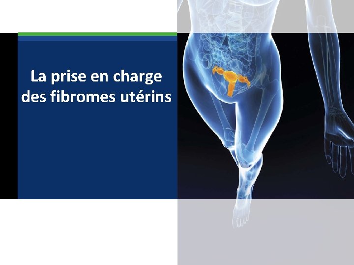  La prise en charge des fibromes utérins 