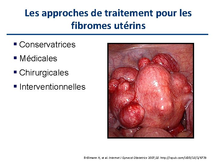 Les approches de traitement pour les fibromes utérins Conservatrices Médicales Chirurgicales Interventionnelles Uterine artery