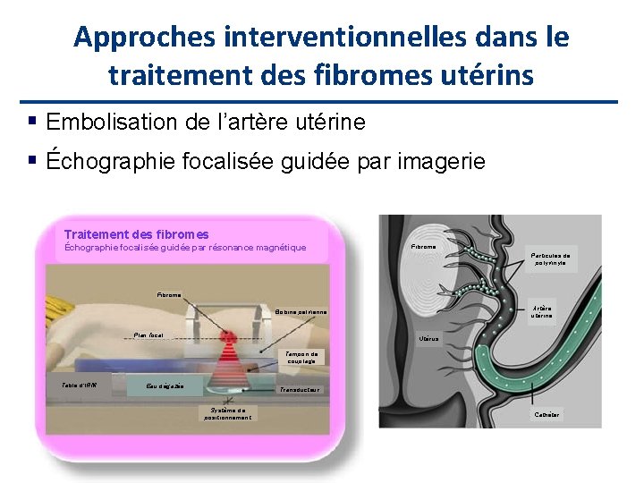 Approches interventionnelles dans le traitement des fibromes utérins Embolisation de l’artère utérine Échographie focalisée