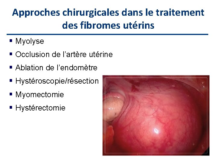 Approches chirurgicales dans le traitement des fibromes utérins Myolyse Occlusion de l’artère utérine Ablation