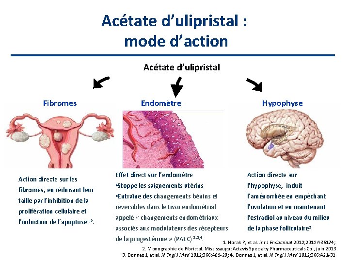 Acétate d’ulipristal : mode d’action Acétate d’ulipristal Fibromes Action directe sur les fibromes, en