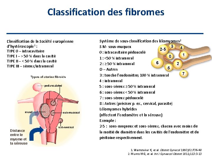 Classification des fibromes Classification de la Société européenne d’hystéroscopie 1 : TYPE 0 –