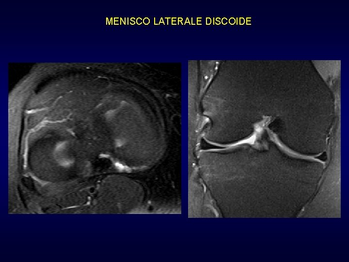 MENISCO LATERALE DISCOIDE MENISCO LATERALE DISCOIDE