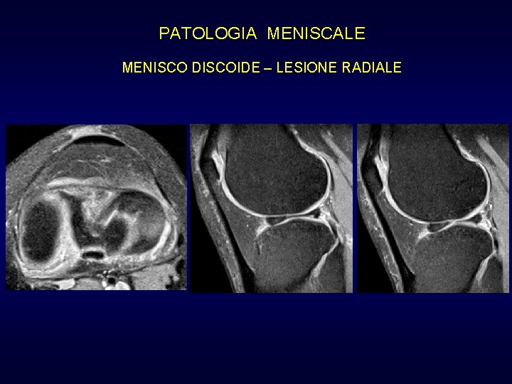 PATOLOGIA MENISCALE MENISCO DISCOIDE – LESIONE RADIALE PATOLOGIA MENISCALE MENISCO DISCOIDE – LESIONE RADIALE