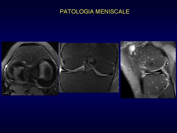 PATOLOGIA MENISCALE PATOLOGIA MENISCALE