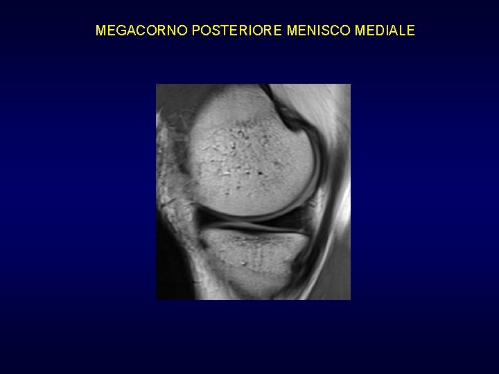 MEGACORNO POSTERIORE MENISCO MEDIALE MEGACORNO POSTERIORE MENISCO MEDIALE