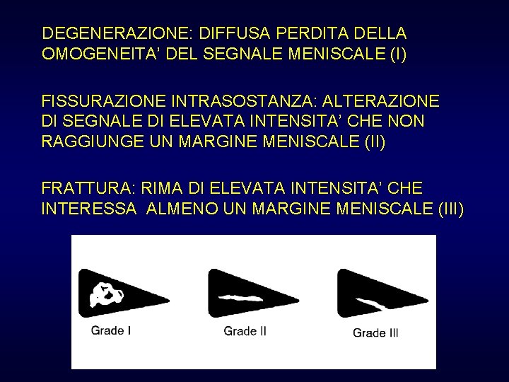 DEGENERAZIONE: DIFFUSA PERDITA DELLA OMOGENEITA’ DEL SEGNALE MENISCALE (I) FISSURAZIONE INTRASOSTANZA: ALTERAZIONE DI SEGNALE DEGENERAZIONE: DIFFUSA PERDITA DELLA OMOGENEITA’ DEL SEGNALE MENISCALE (I) FISSURAZIONE INTRASOSTANZA: ALTERAZIONE DI SEGNALE