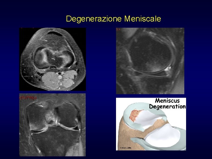 Degenerazione Meniscale Degenerazione Meniscale