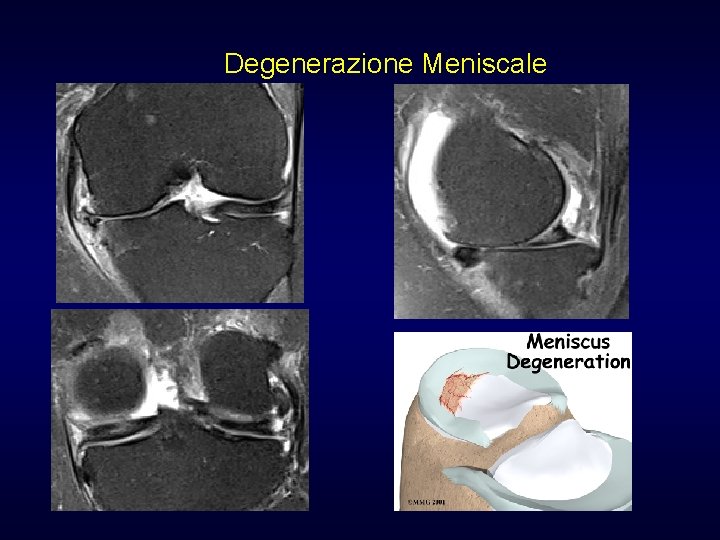 Degenerazione Meniscale Degenerazione Meniscale