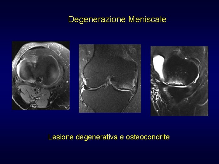 Degenerazione Meniscale Lesione degenerativa e osteocondrite Degenerazione Meniscale Lesione degenerativa e osteocondrite
