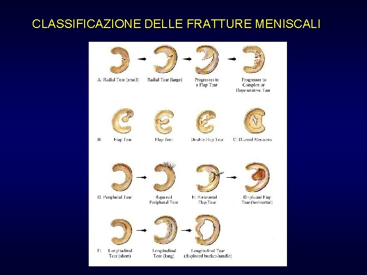 CLASSIFICAZIONE DELLE FRATTURE MENISCALI CLASSIFICAZIONE DELLE FRATTURE MENISCALI