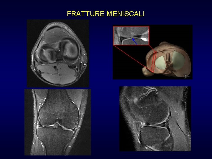 FRATTURE MENISCALI FRATTURE MENISCALI
